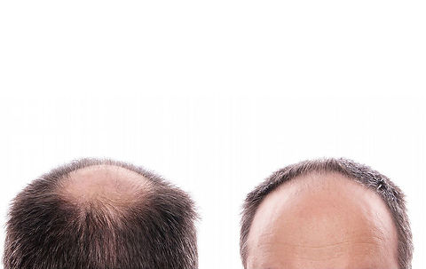 ¿QUÉ ES LA ALOPECIA ANDROGENÉTICA?